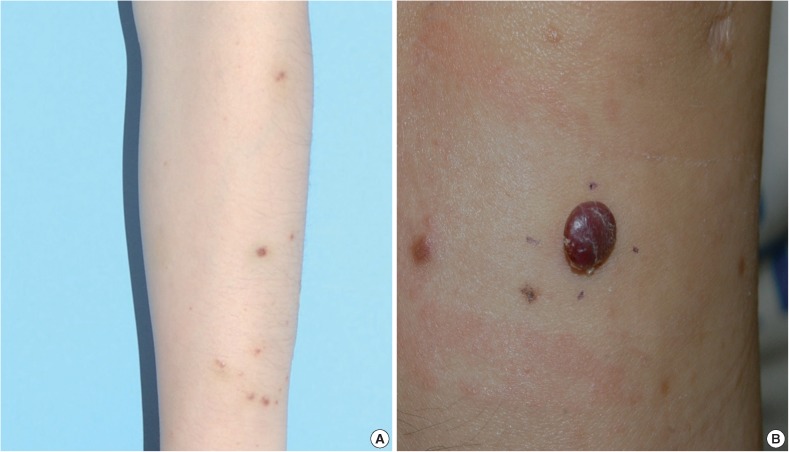 Solid form of epithelioid hemangioma: a case report.