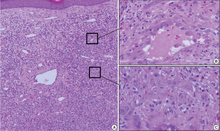 Solid form of epithelioid hemangioma: a case report.