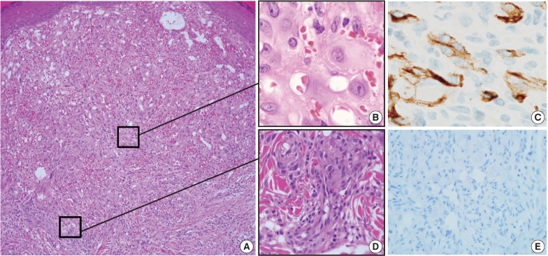 Solid form of epithelioid hemangioma: a case report.