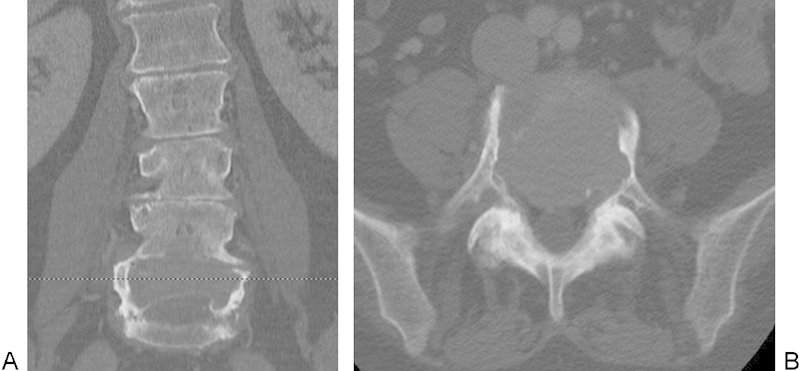 L4 and L5 spondylectomy for en bloc resection of giant cell tumor and review of the literature.