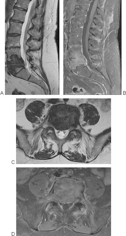 L4 and L5 spondylectomy for en bloc resection of giant cell tumor and review of the literature.