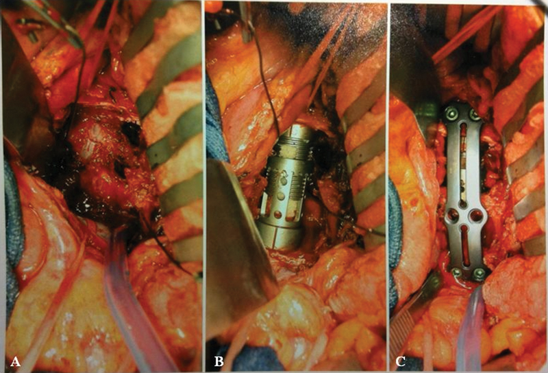 L4 and L5 spondylectomy for en bloc resection of giant cell tumor and review of the literature.