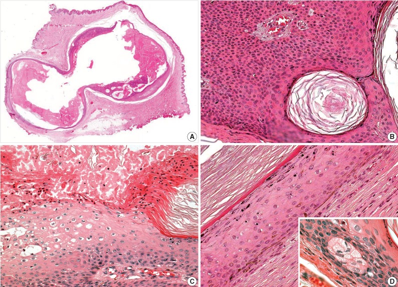 Detection of human papillomavirus type 39 in a seborrheic inclusion cyst of the buttock.