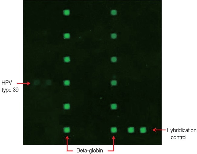 Detection of human papillomavirus type 39 in a seborrheic inclusion cyst of the buttock.