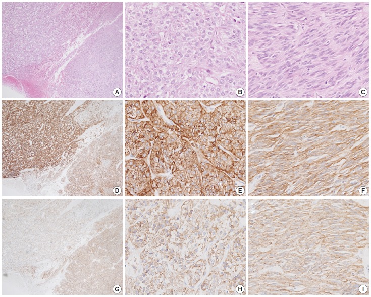 Cytokeratin-positive gastrointestinal stromal tumor of biphasic morphology: a case report.