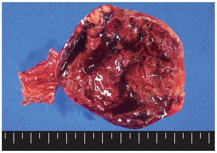 Cytokeratin-positive gastrointestinal stromal tumor of biphasic morphology: a case report.