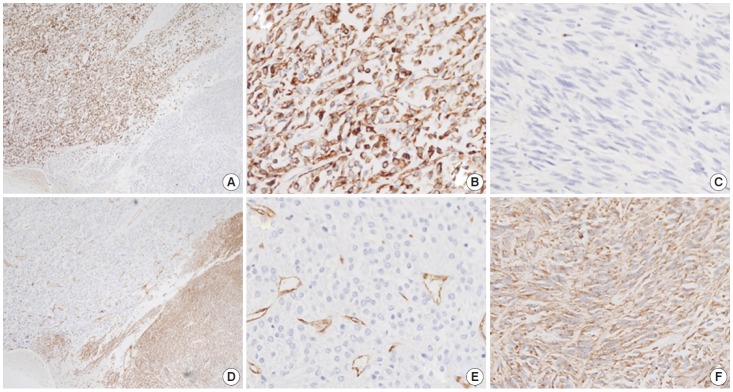 Cytokeratin-positive gastrointestinal stromal tumor of biphasic morphology: a case report.