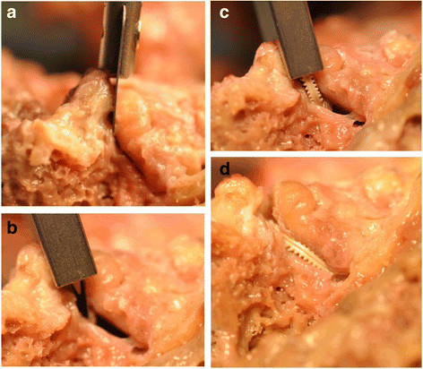 Minimally invasive facet restoration implant for chronic lumbar zygapophysial pain: 1-year outcomes.