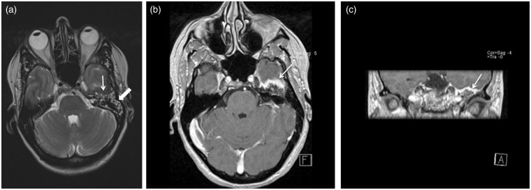 A case of a temporal bone meningioma presenting as a serous otitis media.