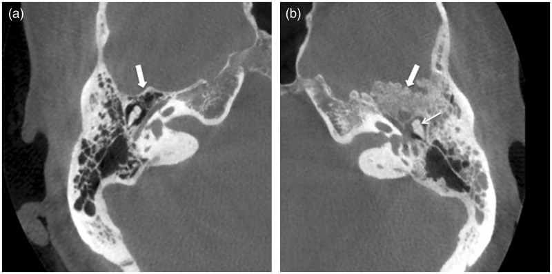 A case of a temporal bone meningioma presenting as a serous otitis media.