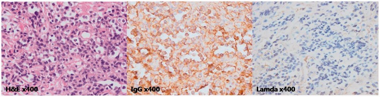 Imaging features of bilateral breast plasmacytoma as unusual initial presentation of multiple myeloma: case report and literature review.