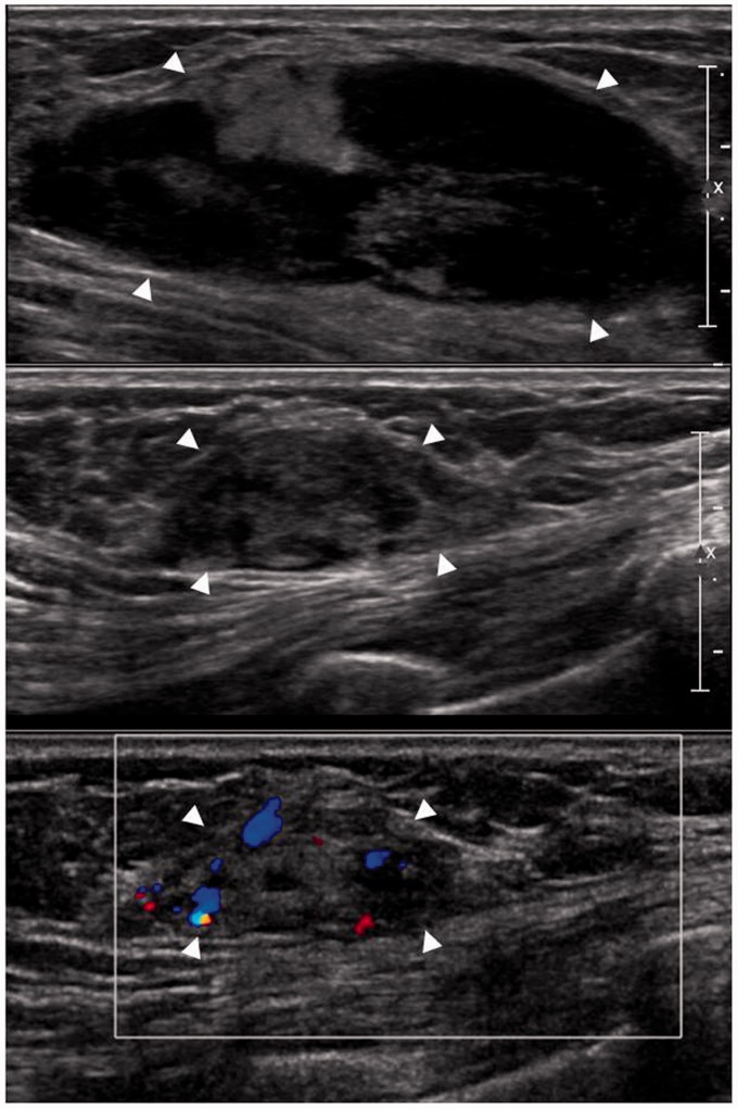 Imaging features of bilateral breast plasmacytoma as unusual initial presentation of multiple myeloma: case report and literature review.