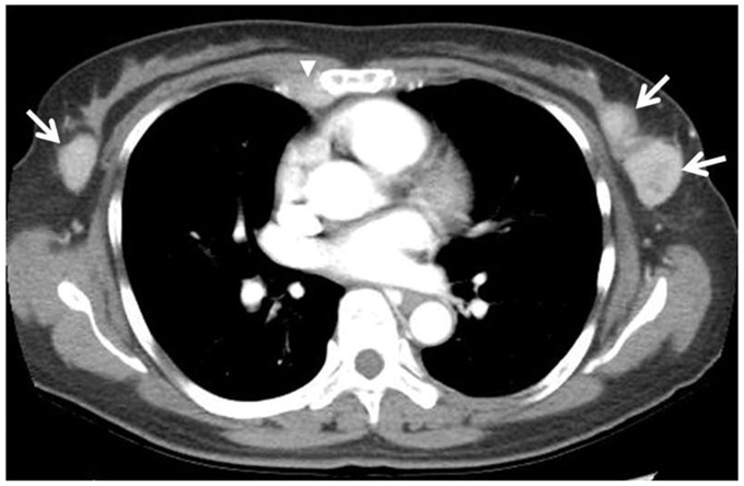 Imaging features of bilateral breast plasmacytoma as unusual initial presentation of multiple myeloma: case report and literature review.