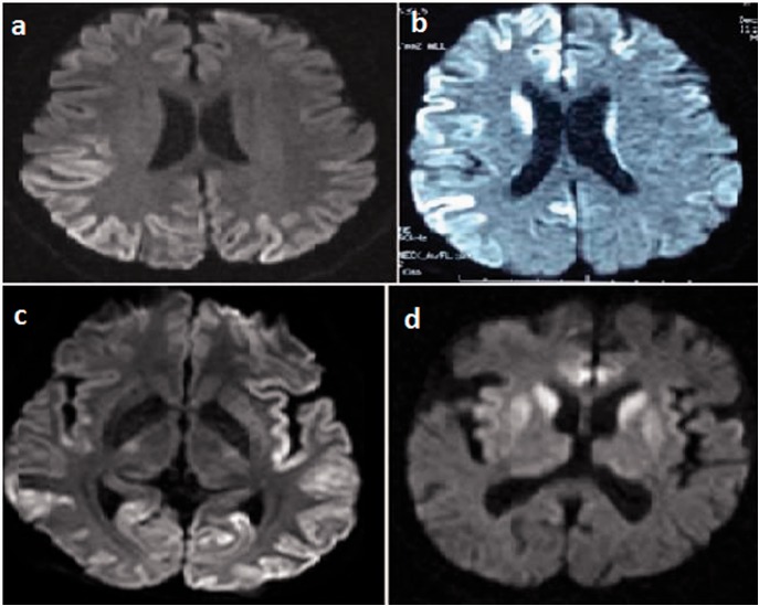 Magnetic resonance imaging findings in probable Creutzfeld-Jacob disease: comparison with electroencephalography and cerebrospinal fluid characteristics.