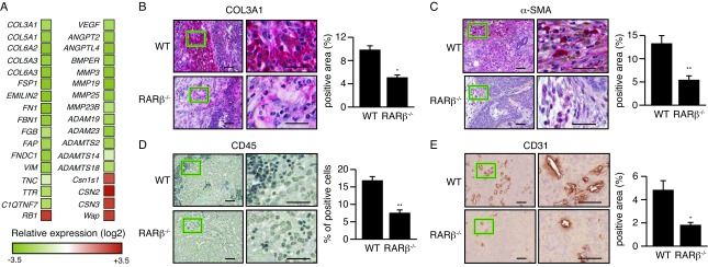 Inactivation of RARβ inhibits Wnt1-induced mammary tumorigenesis by suppressing epithelial-mesenchymal transitions.