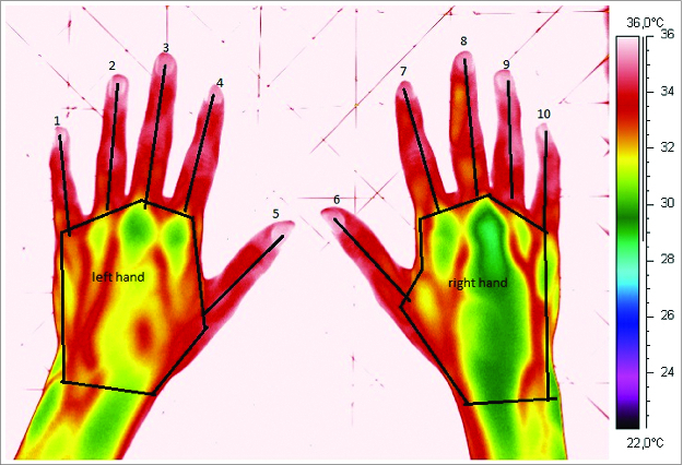 The effect of oral uptake of nicotine in snus on peripheral skin blood circulation evaluated by thermography.