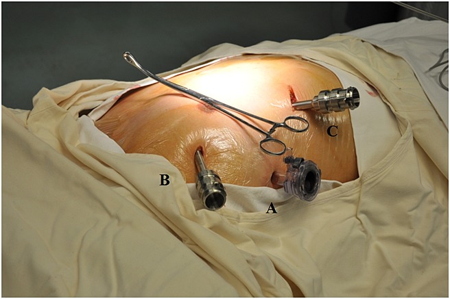 Initial experience of robot-assisted thoracoscopic surgery in China.