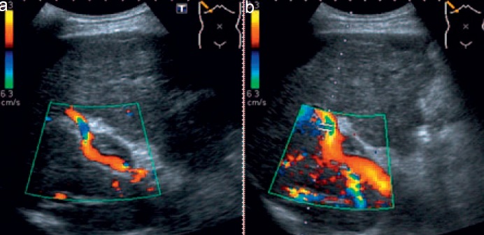 Radiological Diagnosis of Portal/Mesenteric Vein Occlusion.