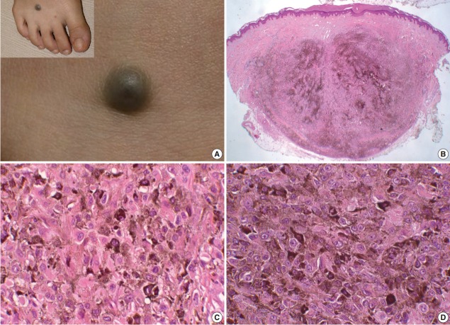 A case of epithelioid blue nevus.