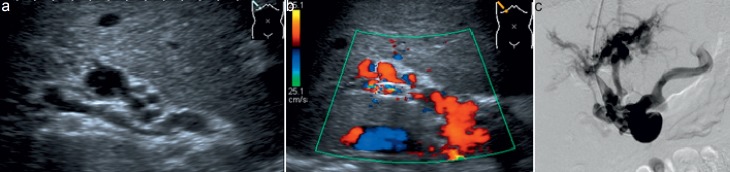 Radiological Diagnosis of Portal/Mesenteric Vein Occlusion.