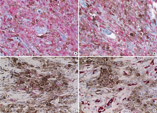 A case of epithelioid blue nevus.