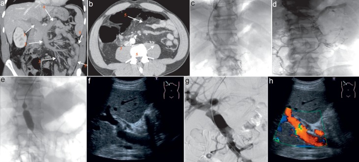 Radiological Diagnosis of Portal/Mesenteric Vein Occlusion.