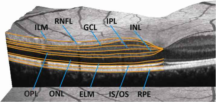 Optical coherence tomography for retinal imaging in multiple sclerosis.