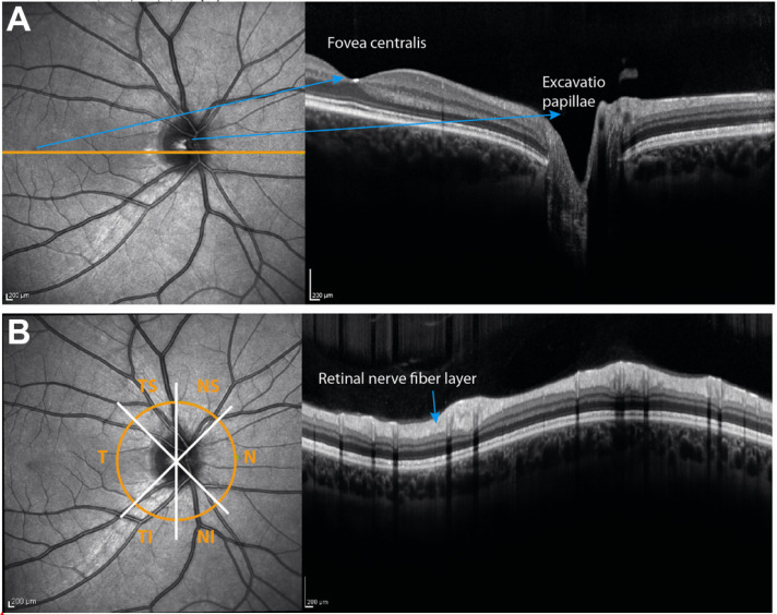 Optical coherence tomography for retinal imaging in multiple sclerosis.