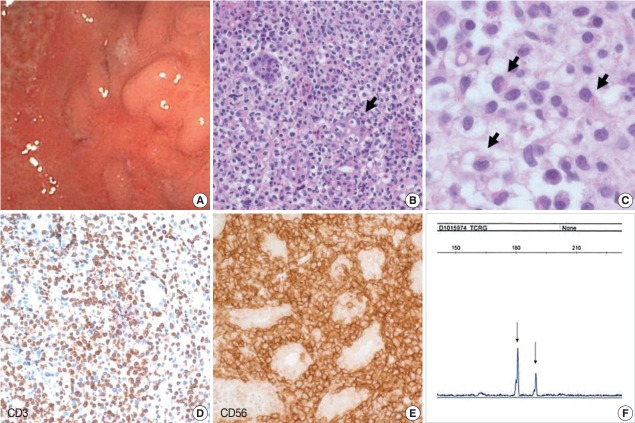 Indolent CD56-Positive Clonal T-Cell Lymphoproliferative Disease of the Stomach Mimicking Lymphomatoid Gastropathy.