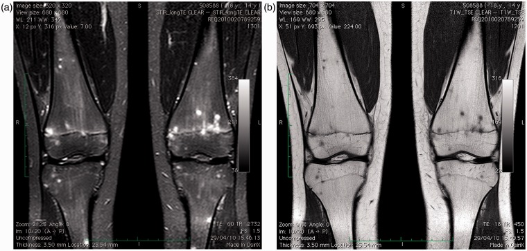 Whole-body MRI as an unconventional diagnostic tool in a pediatric patient with systemic infection.