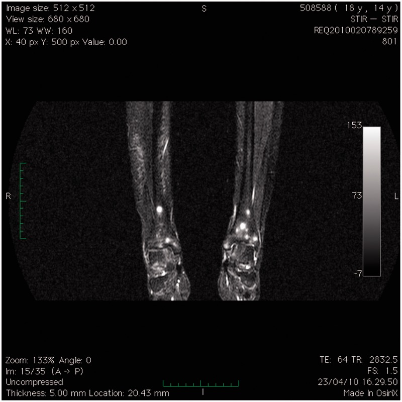 Whole-body MRI as an unconventional diagnostic tool in a pediatric patient with systemic infection.
