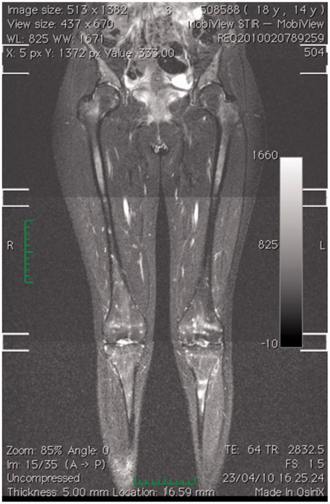 Whole-body MRI as an unconventional diagnostic tool in a pediatric patient with systemic infection.