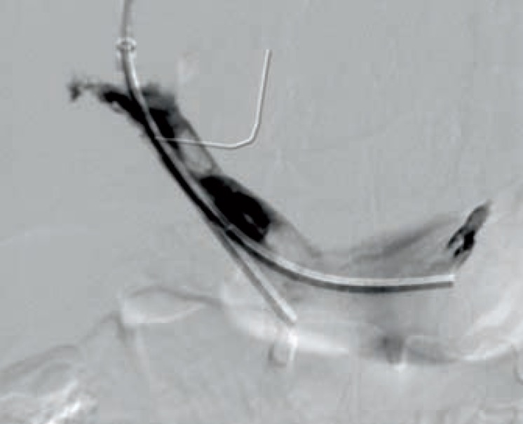 Nonsurgical Therapeutic Options in Portal Vein Thrombosis.