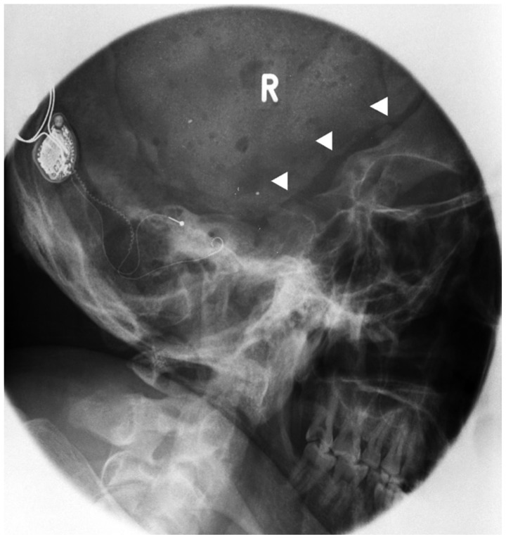A case of cochlear implantation targeting preserved cerebral cortex in severe traumatic brain injury.