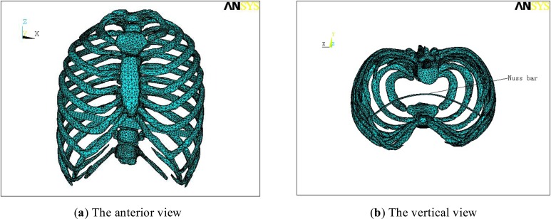 Numerical Simulation and Clinical Verification of the Minimally Invasive Repair of Pectus Excavatum.