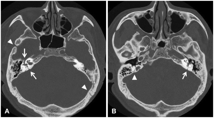 A case of cochlear implantation targeting preserved cerebral cortex in severe traumatic brain injury.