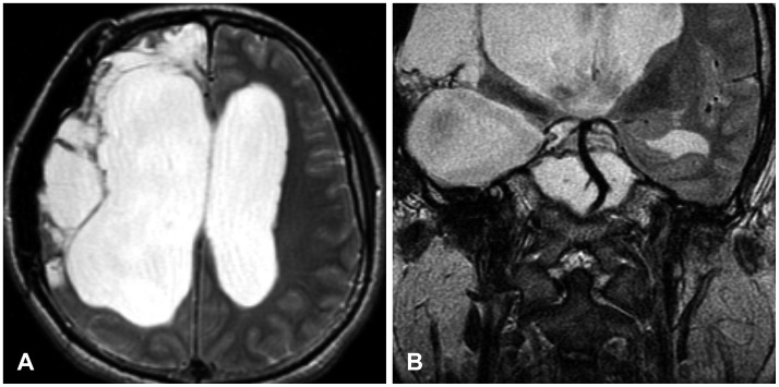 A case of cochlear implantation targeting preserved cerebral cortex in severe traumatic brain injury.