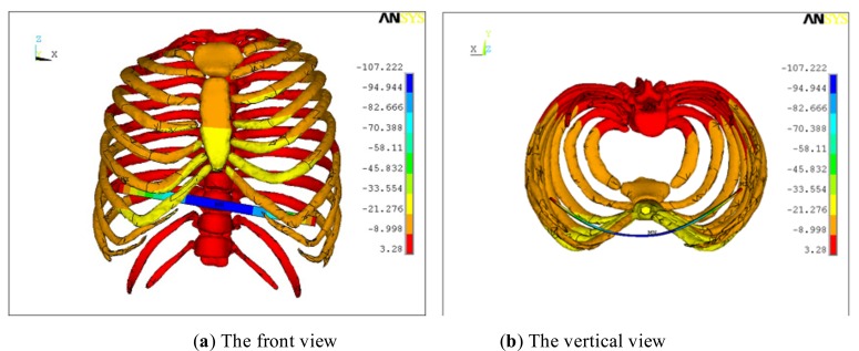 Numerical Simulation and Clinical Verification of the Minimally Invasive Repair of Pectus Excavatum.