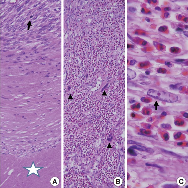 Primary leiomyosarcoma of adrenal gland with tissue eosinophilic infiltration.