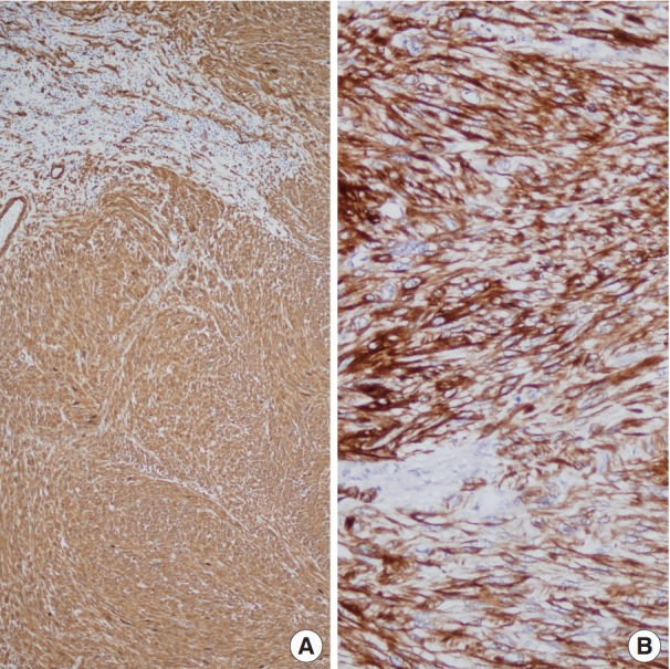 Primary leiomyosarcoma of adrenal gland with tissue eosinophilic infiltration.