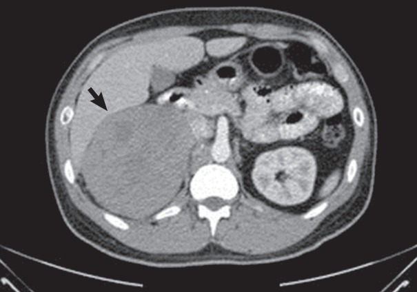 Primary leiomyosarcoma of adrenal gland with tissue eosinophilic infiltration.