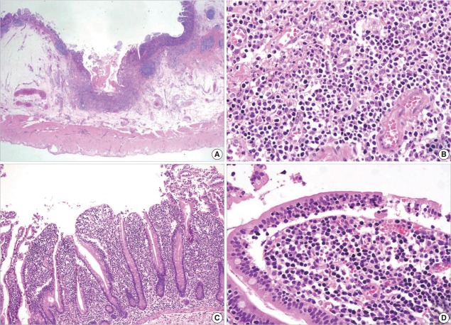 A Case of Type II Enteropathy-Associated T-Cell Lymphoma with Epstein-Barr Virus Positivity.