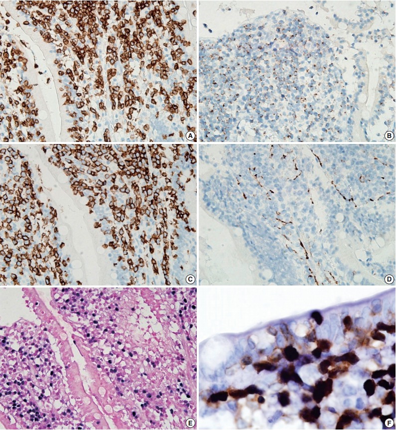 A Case of Type II Enteropathy-Associated T-Cell Lymphoma with Epstein-Barr Virus Positivity.