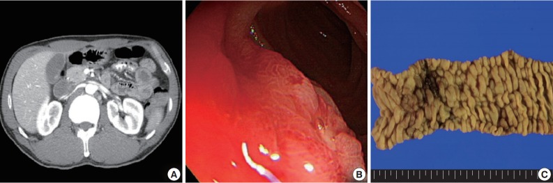 A Case of Type II Enteropathy-Associated T-Cell Lymphoma with Epstein-Barr Virus Positivity.