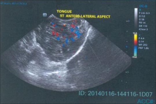 A new venture with sclerotherapy in an oral vascular lesion.