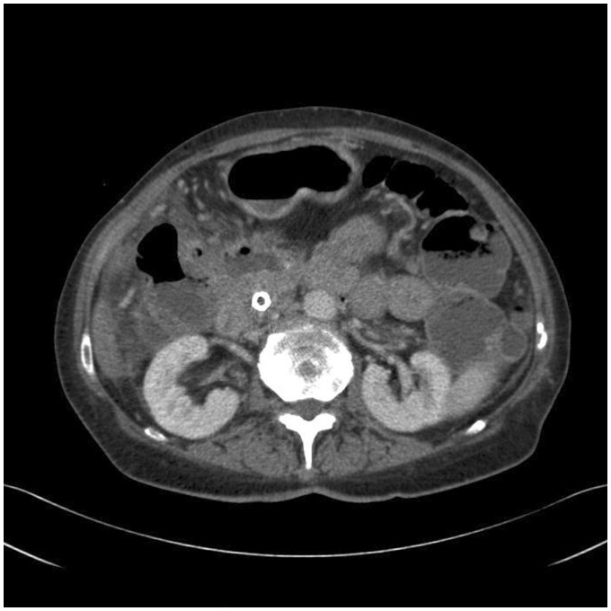 Severe complications with irreversible electroporation of the pancreas in the presence of a metallic stent: a warning of a procedure that never should be performed.