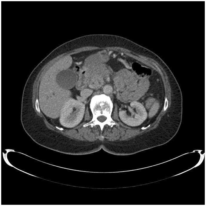 Severe complications with irreversible electroporation of the pancreas in the presence of a metallic stent: a warning of a procedure that never should be performed.