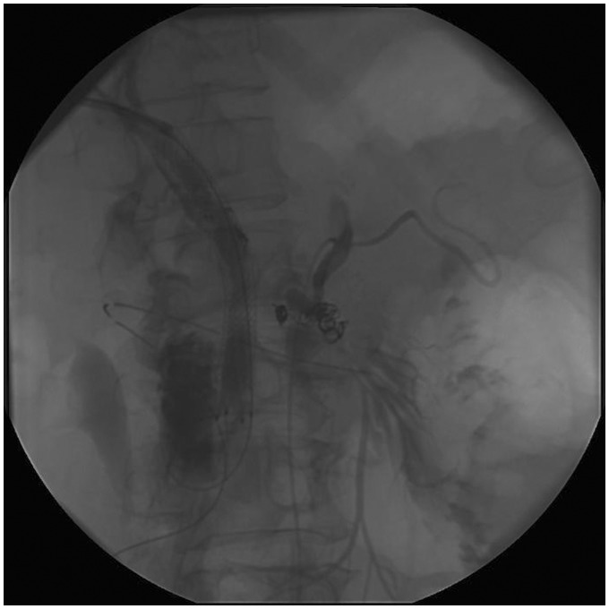 Severe complications with irreversible electroporation of the pancreas in the presence of a metallic stent: a warning of a procedure that never should be performed.