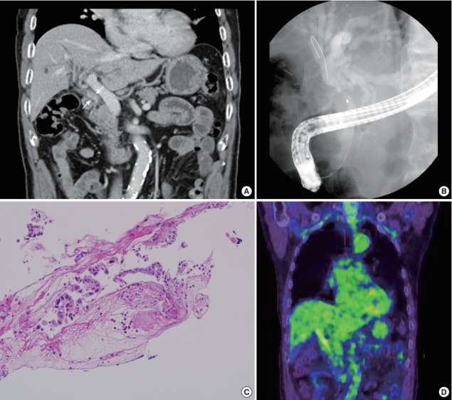 A case of mixed adenoneuroendocrine carcinoma of the common bile duct: initially diagnosed as cholangiocarcinoma.