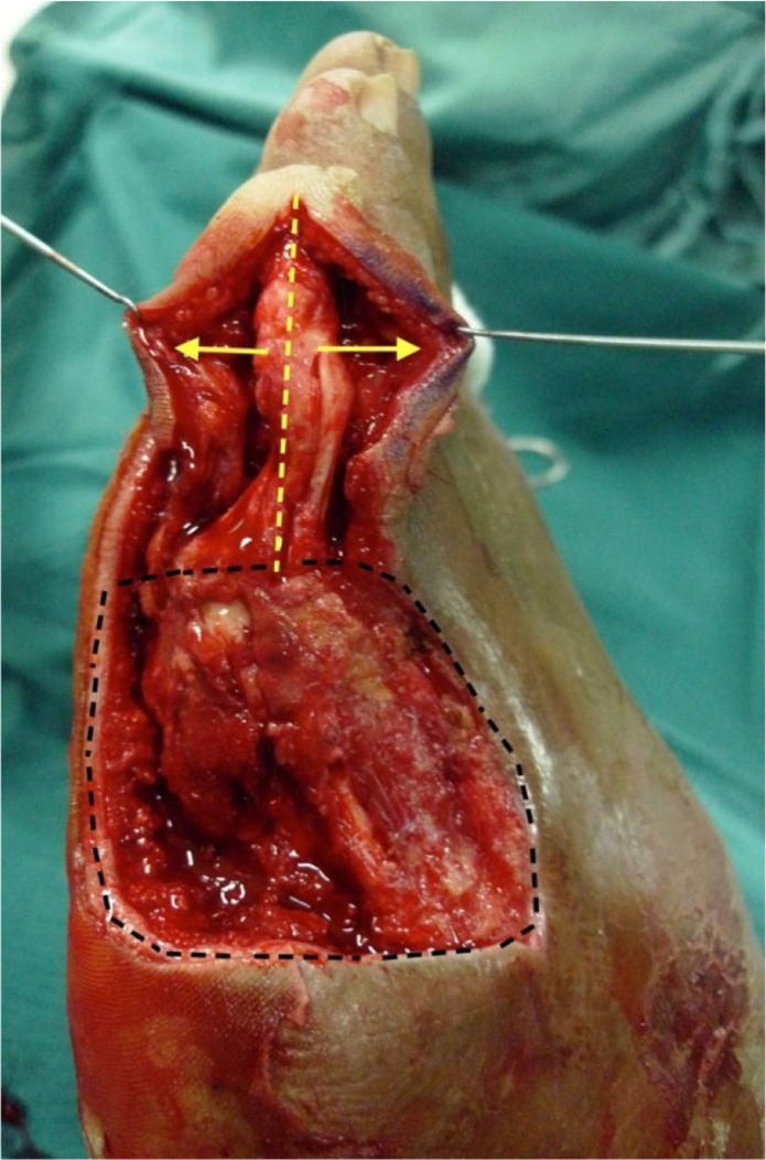 The lateral lesser toe fillet flap for diabetic foot soft tissue closure: surgical technique and case report.